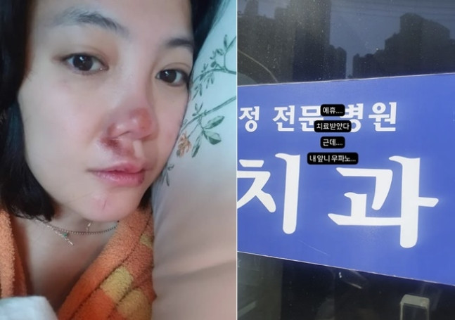Go Eun-ah Suffers Serious Facial Injury After Nine-Hour Nose Surgery